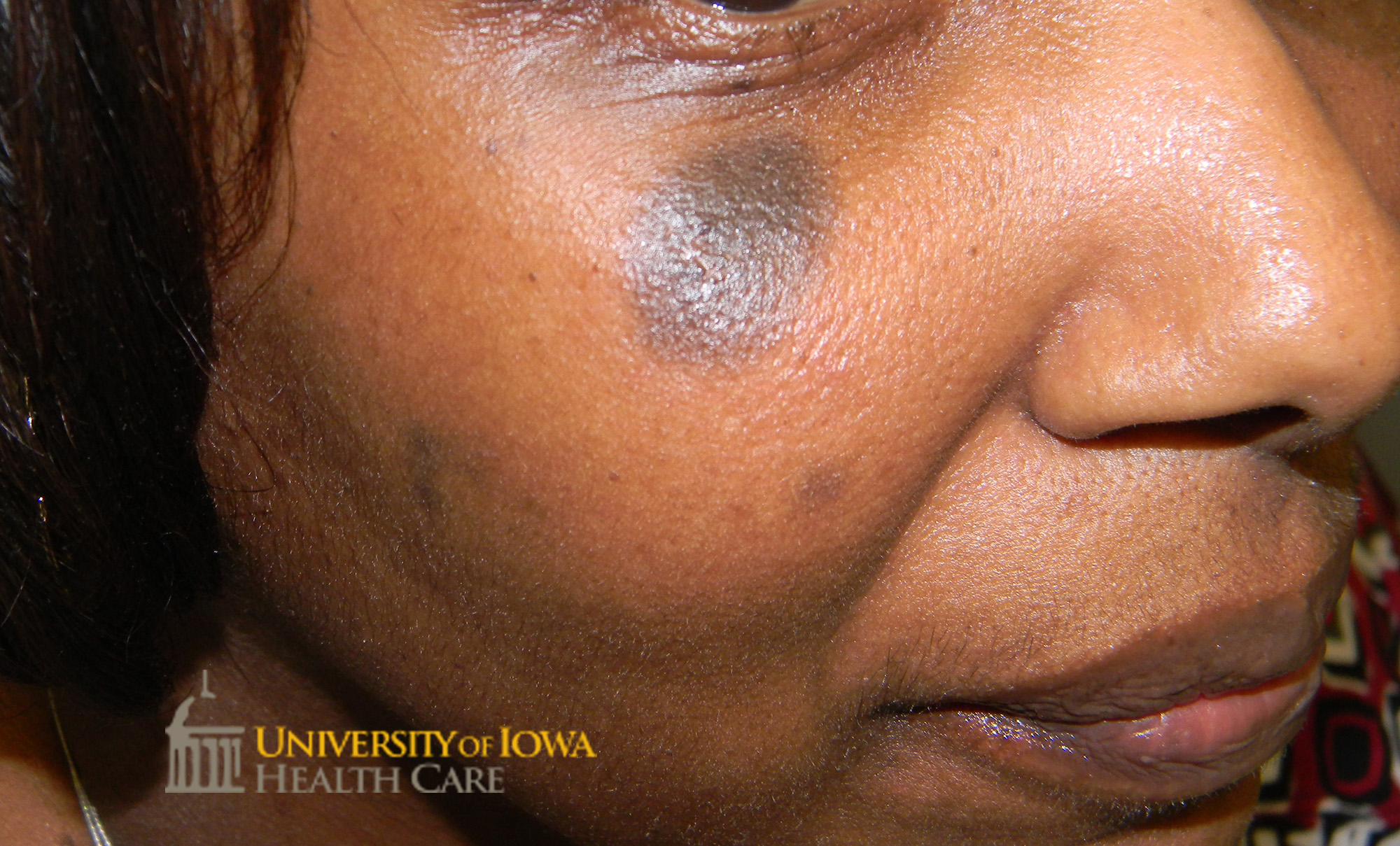 Dark gray round thin plaque on the cheek. (click images for higher resolution).